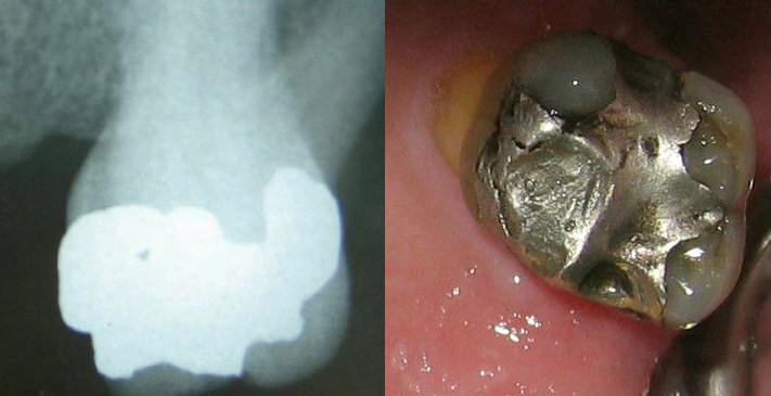 dental amalgam